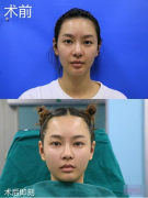 杭州華山連天美做的全臉脂肪填充,術(shù)后100天效果