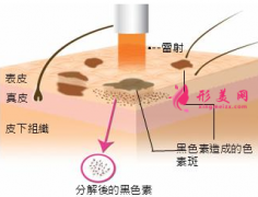 激光祛斑大概需要做幾次