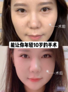 重慶軍美醫(yī)院的武劍醫(yī)生做的面部脂肪填充案例，花了12000元