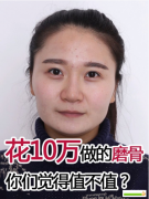 上海首爾麗格樸興植醫(yī)生做的磨骨手術，價格10萬元
