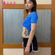 北京潤(rùn)美玉之光王明利醫(yī)生腰腹吸脂術(shù)后恢復(fù)效果展示