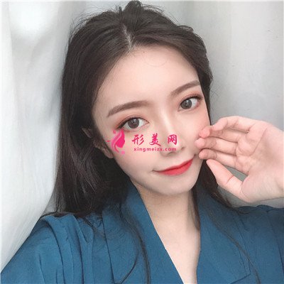 杭州切開(kāi)雙眼皮術(shù)后恢復(fù)效果反饋