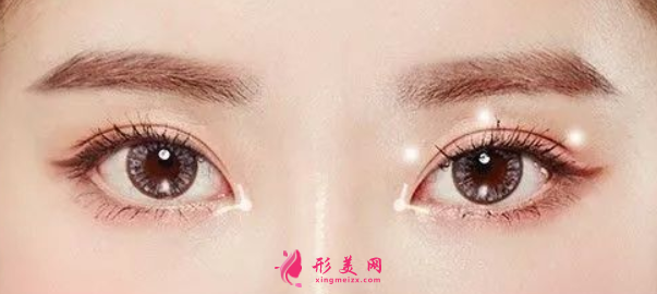 雙眼皮手術(shù)的費(fèi)用是多少