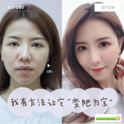廣州廣大整形美容醫(yī)院做的自體脂肪面部填充，價格不到兩萬