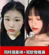 重慶軍美醫(yī)療美容醫(yī)院董志勇醫(yī)生的膨體+耳軟骨隆鼻案例