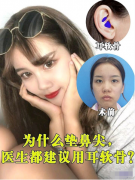 南京美貝爾整形醫(yī)院的黃名斗醫(yī)生隆鼻案例，做出的鼻尖真的太美了