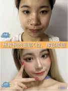 廣州廣大做硅膠隆鼻，術(shù)后三個月效果