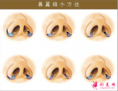 縮鼻手術(shù)后遺癥是什么？