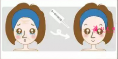 打玻尿酸后多久開始消腫？