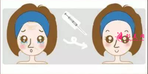 打玻尿酸后多久開始消腫