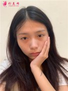 四川華人醫(yī)聯(lián)整形美容醫(yī)院切開雙眼皮術(shù)后恢復(fù)效果分享圖
