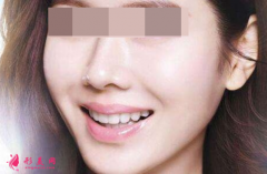 自體脂肪填充臉部恢復(fù)時間要多久？