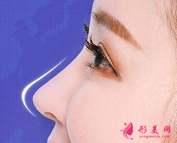 假體隆鼻術(shù)后需要做的護(hù)理事項