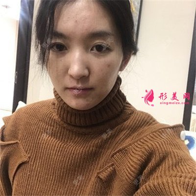 杭州熱瑪吉術(shù)后恢復(fù)情況對(duì)比