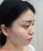 上海華美醫(yī)療美容醫(yī)院注射玻尿酸效果驚艷