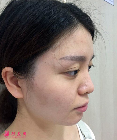 上海注射玻尿酸效果驚艷