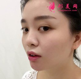 上海注射玻尿酸效果驚艷