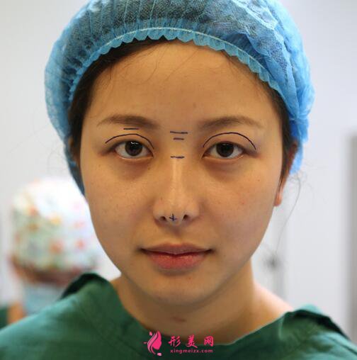 #術前了解#熱瑪吉除皺能維持多久？效果好不好呢？
