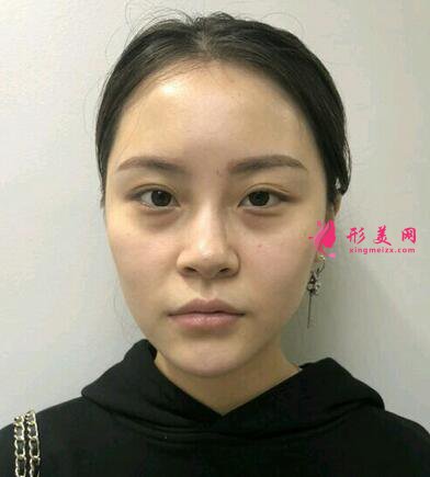#術前了解#熱瑪吉除皺能維持多久？效果好不好呢？
