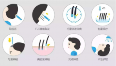 什么是FUT植發(fā)技術和FUE植發(fā)技術？有什么區(qū)別?