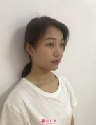 四川華人醫(yī)聯(lián)切開雙眼皮術(shù)后一個(gè)月恢復(fù)圖分享~來看看吧