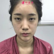 重慶西南醫(yī)院整形科隆鼻失敗修復(fù)案例~看看術(shù)后效果怎么樣