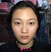 北京沃爾劉彥軍隆鼻失敗修復(fù)案例~術(shù)后兩個(gè)月效果分享