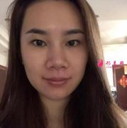 上海九院蘇薇潔做雙眼皮怎么樣？看看我的案例~術(shù)后兩個(gè)月效果很
