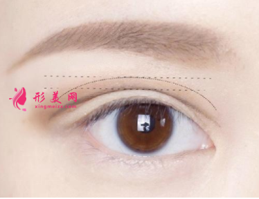 雙眼皮術(shù)后怎么恢復(fù)得快