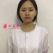 鄭州締萊美面部吸脂真實案例分享，小臉就是好看