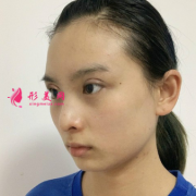 北京京民整形外科切開雙眼皮+開內(nèi)眼角手術(shù)案例分享