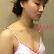 上海華美隆胸的效果如何，看我三個(gè)月的效果好不好
