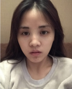 上海九院隆鼻貴不貴？做了鼻綜合面部整體立體感出來了