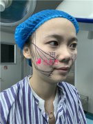 廣州廣大整形美容醫(yī)院小姐姐面部線雕提升術(shù)后效果對比