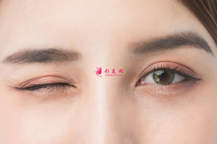 雙眼皮手術(shù)的消腫期是多久