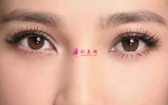 雙眼皮手術的消腫期是多久？