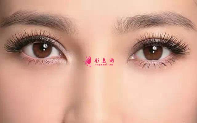 雙眼皮手術(shù)的消腫期是多久