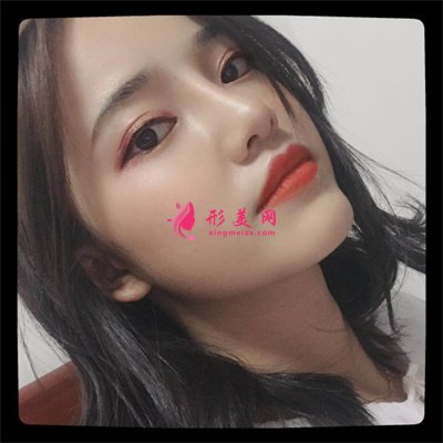 合肥鼻部綜合術(shù)后恢復(fù)情況分享