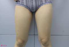上海伯思立吸脂瘦大腿的詳細(xì)過程分享~快來看術(shù)后效果好不好