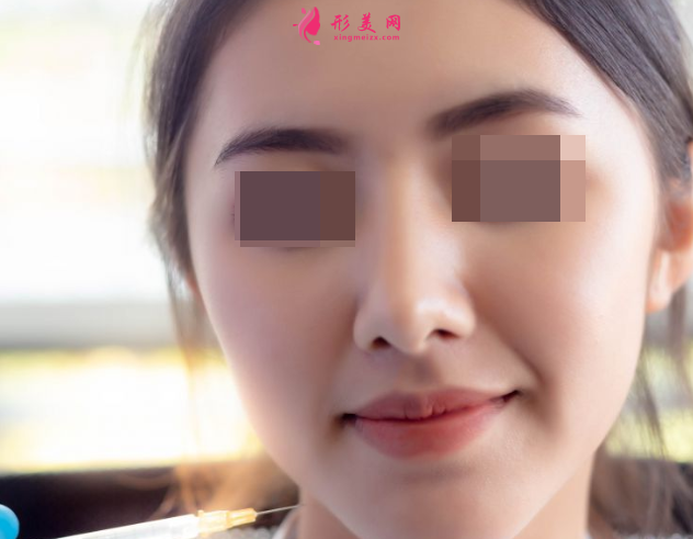 自體脂肪填充面部需要注射多少次