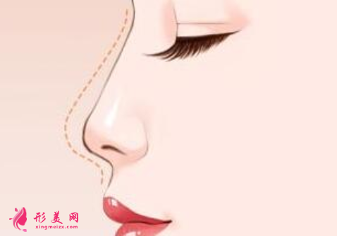 自體軟骨隆鼻什么時候拆線
