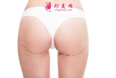 臀部吸脂術(shù)后的護理事項