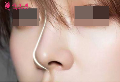 自體軟骨隆鼻恢復(fù)期內(nèi)的護(hù)理事項(xiàng)