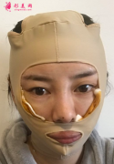 上海首爾麗格顴骨內推怎么樣，降低你的顴骨變成自己的女神