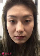 四川米蘭柏羽全臉填充怎么樣？來看看自體脂肪填充案例