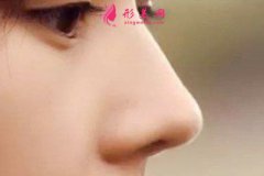 自體軟骨隆鼻價(jià)格怎么樣？