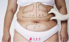 腰腹部吸脂要多久恢復(fù)好？