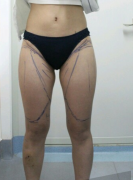 四川友誼醫(yī)院整形美容做大腿360°環(huán)柔吸脂的術(shù)后恢復(fù)日記