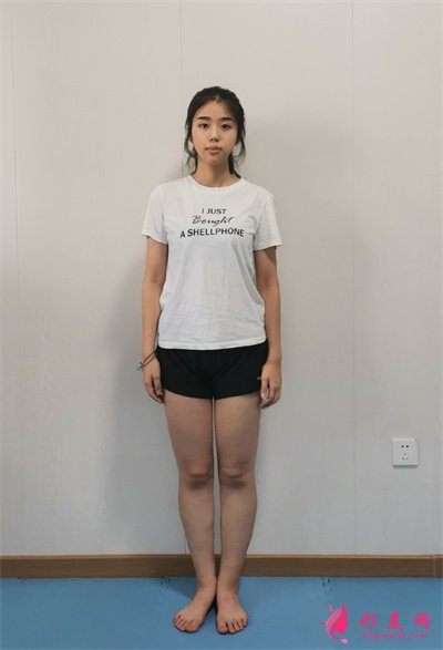 重慶水動力吸脂瘦大腿術(shù)后效果對比