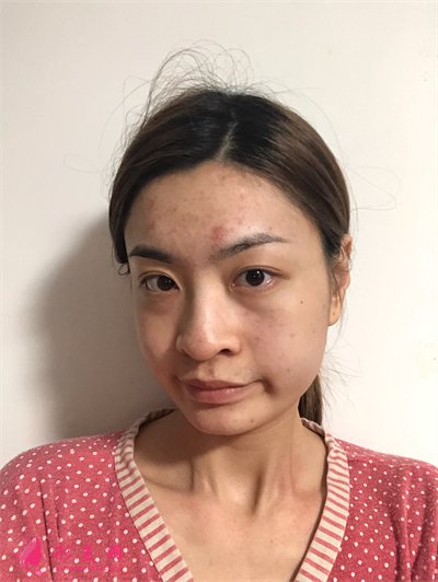 北京小姐姐鼻翼縮小術(shù)后效果反饋